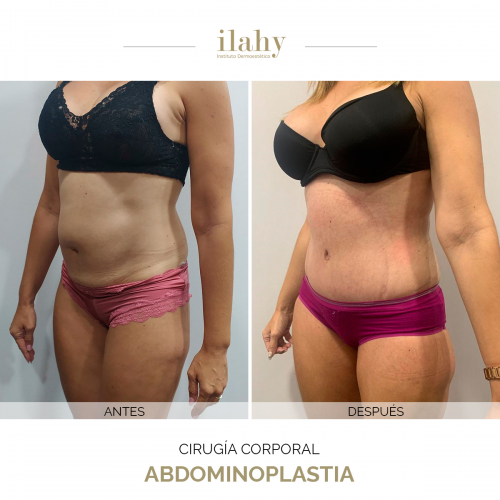 Abdominoplastia - Caso de antes y despu�s